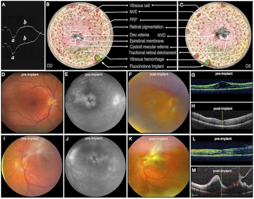 ADNIV case